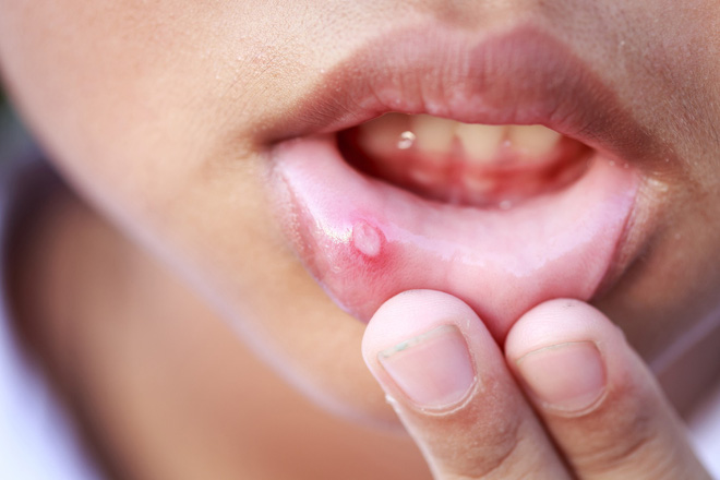 7 triệu chứng thường gặp của bệnh ung thư miệng mà nhiều người hay nhầm lẫn - Ảnh 1.