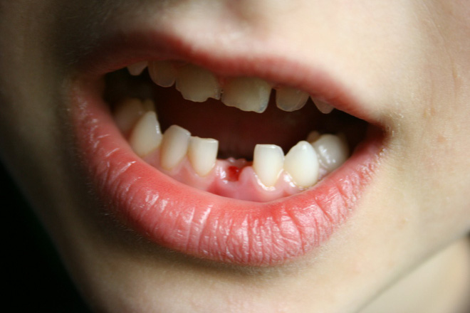 7 triệu chứng thường gặp của bệnh ung thư miệng mà nhiều người hay nhầm lẫn - Ảnh 5.